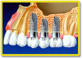 dental-implant-thailand-01.jpg